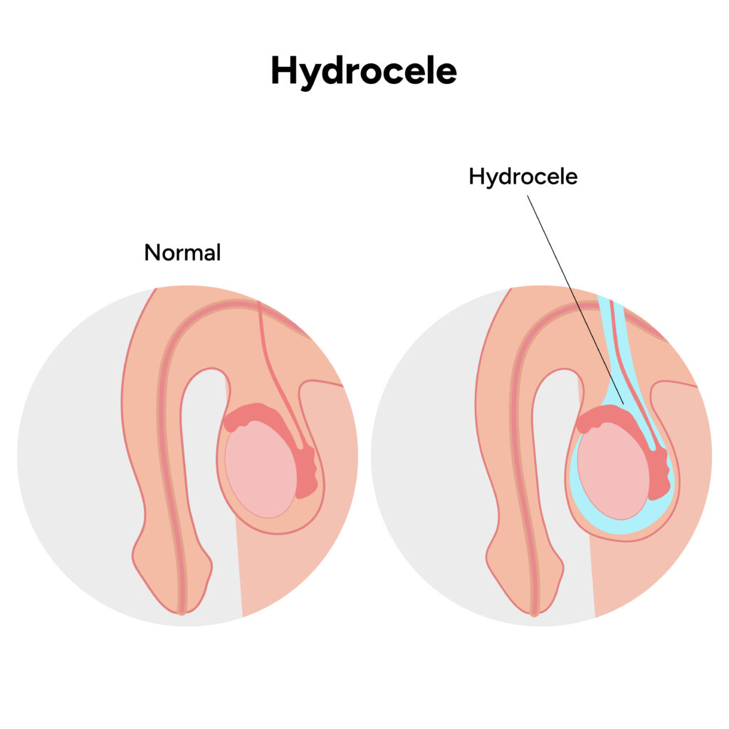 הידרוצלה