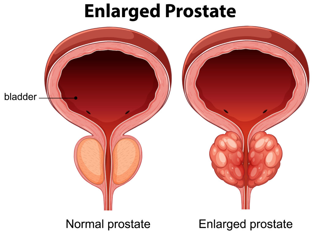 פרוסטטה (ערמונית)